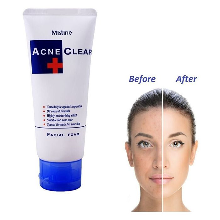 Acne Clear Facial Foam Wash, 85ml ZE Enterprises